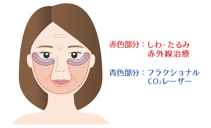 フラクショナルCO2レーザー治療 各部位の範囲（眼の下～こめかみ）
