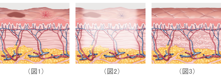 赤外線治療（フォトフェイシャル® M22）のイメージ図